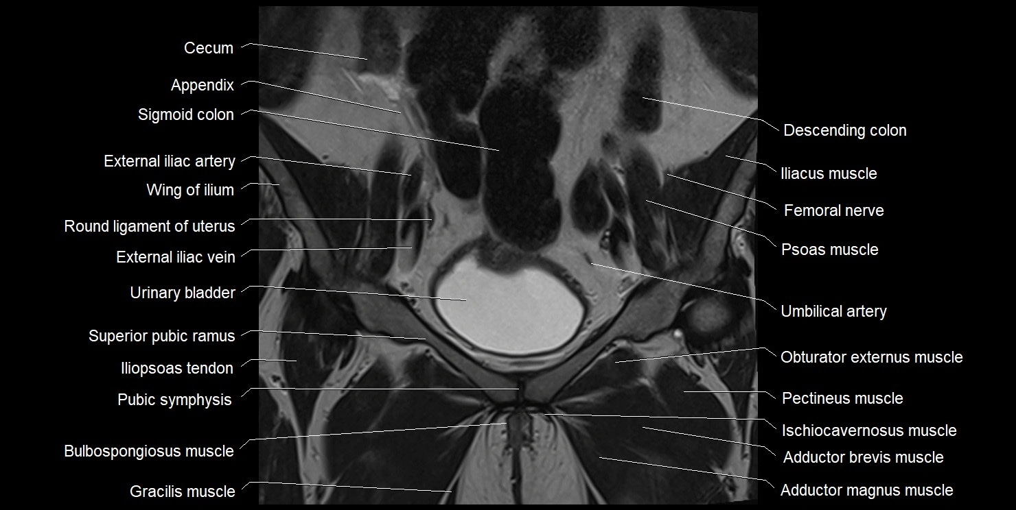female pelvis coronal cross sectional anatomy image 11.webp
